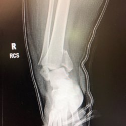 Ross H. Talarico, DPM - My broken ankle.