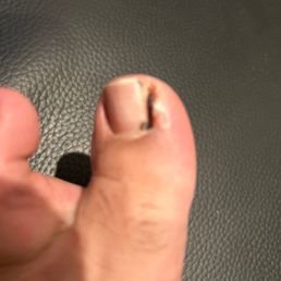 Injured toe