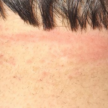 Great Clips - The back of my neck was red and hurt hours after she used the clippers on my neck. It stung when she did it too. - Hair Salons Near Me - Modesto, California Great Clips - The back of my neck was red and hurt hours after she used the clippers on my neck. It stung when she did it too. - Hair Salons Near Me - Modesto, California