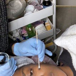 Brighter You - Photo receiving spot chemical peel to clear dark mark from pimple.