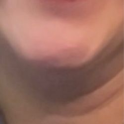 Pure Skin MedSpa - Lip filler- bumps on inner lining of upper lip
