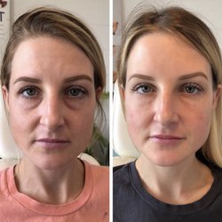 HēBē Skin Health - Full facial augmentation using Dysport and Fillers.