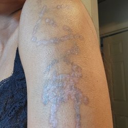 Serenity Tattoo Removal