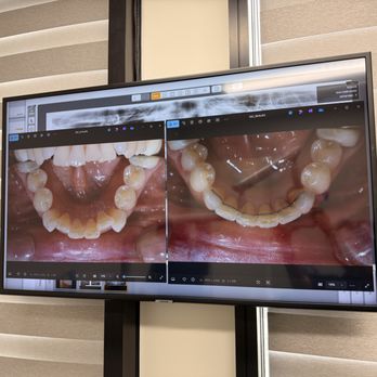Joon Choe, DDS - before and after from the doc's office - Orthodontists Near Me - Buena Park, California Joon Choe, DDS - before and after from the doc's office - Orthodontists Near Me - Buena Park, California
