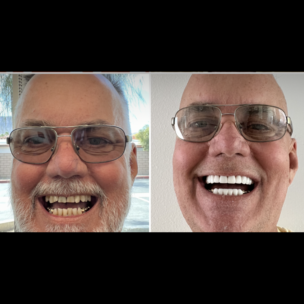 Rancho Mirage Dental Group - march 13 before
April 14 finished product - General Dentistry Near Me - Rancho Mirage, California Rancho Mirage Dental Group - march 13 before
April 14 finished product - General Dentistry Near Me - Rancho Mirage, California