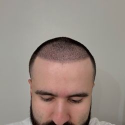 Dr. Serkan Aygın Clinic - Post scabs falling off.