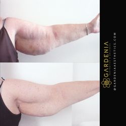 Gardenia Aesthetics & Wellness - Before and after body sculpting treatments for arms.
