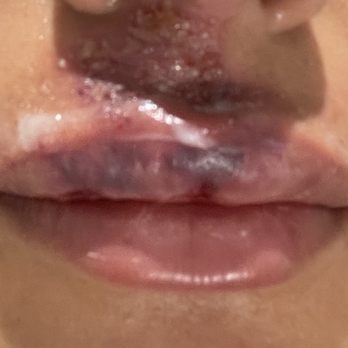 Dryluxe - Infection After Bad Procedure of a Lip Filler Done By Dr. Susan Stuart - Blow Dry/Out Services Near Me - Dobbs Ferry, New York Dryluxe - Infection After Bad Procedure of a Lip Filler Done By Dr. Susan Stuart - Blow Dry/Out Services Near Me - Dobbs Ferry, New York