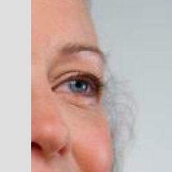 Electrolysis By Diane - Removal of frizzy gray sideburns or any color resistant hair