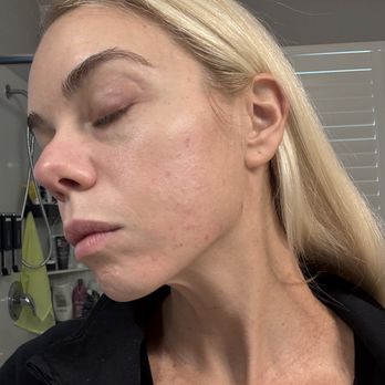 Glow DermSolutions - After the Deep Peel - Medical Spas Near Me - San Jose, California Glow DermSolutions - After the Deep Peel - Medical Spas Near Me - San Jose, California