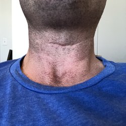 Onz - Cervical ADR scar