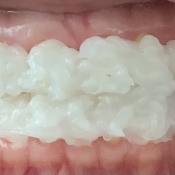 Illumination Teeth Whitening - Teeth Whitening Near Me - Diamond Bar , California Illumination Teeth Whitening - Teeth Whitening Near Me - Diamond Bar , California