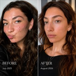 Acne rescue right on Union Street. Esthetics by Roxanne, text or call 415.655.9769