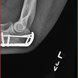 Hands On Hands Rehabilitation Center - New hardware to hold it together.