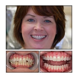 Beach View Family Dental - Before & After Whitening