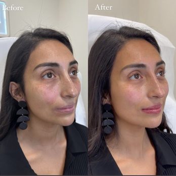 Rumi Aesthetics - Before and after :) - Aestheticians Near Me - Chino, California
