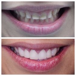 Arcadia Perio Care - Esthetic Crown lengthening