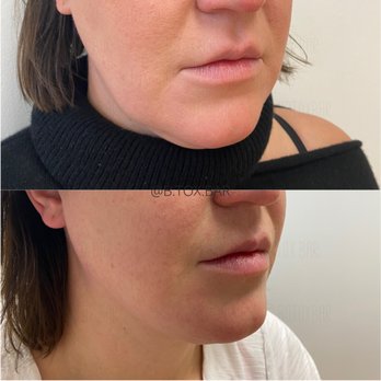 Btoxbar - Before and after PDO thread lift to lower face - Medical Spas Near Me - Los Gatos, California Btoxbar - Before and after PDO thread lift to lower face - Medical Spas Near Me - Los Gatos, California