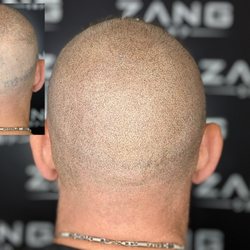 Zang SMP - Bad SMP from anther provider, repaired by us without needing to do laser removal.