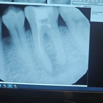 Alderwood Endodontics - Endodontists Near Me - Lynnwood, Washington Alderwood Endodontics - Endodontists Near Me - Lynnwood, Washington