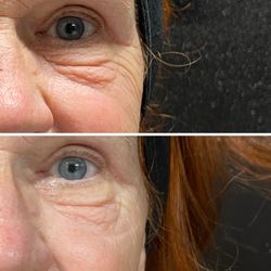 Elevate Wellness Spa - After one treatment of ozone cold jet plasma