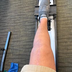 Orthopaedic Sports Specialists - Knee after the bandages and wrapping came off. Better than new!