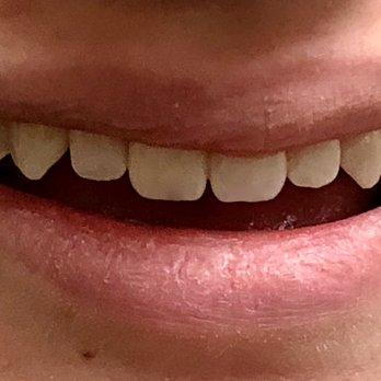 Denys Kovalchuk, DDS - Bet you can't guess which canine tooth is fake! - General Dentistry Near Me - Mill Valley, California Denys Kovalchuk, DDS - Bet you can't guess which canine tooth is fake! - General Dentistry Near Me - Mill Valley, California