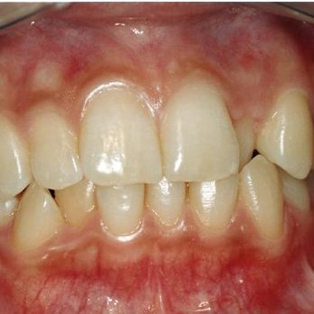 John S K Hsu, DDS - Before orthodontics - Periodontists Near Me - Fairfax, Virginia John S K Hsu, DDS - Before orthodontics - Periodontists Near Me - Fairfax, Virginia