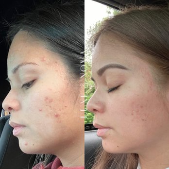 Luxe & Nova - Acne Clear Skin Program - 3 month progress - Skin Care Near Me - Waipahu, Hawaii Luxe & Nova - Acne Clear Skin Program - 3 month progress - Skin Care Near Me - Waipahu, Hawaii