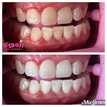 Tooth Gems By Nohemi - Teeth whitening before/after - Teeth Whitening Near Me - Miramar, Florida Tooth Gems By Nohemi - Teeth whitening before/after - Teeth Whitening Near Me - Miramar, Florida