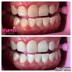 Teeth whitening before/after