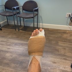 Alvera Podiatry Group - Second post op after bunion surgery.