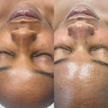 Laserlicious - That Hydrafacial Glow!
Clear, bright, younger looking skin. - Medical Spas Near Me - Etobicoke, Ontario