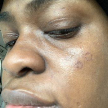 Massage Envy - Two burns on my cheek - Massage Therapy Near Me - Montgomery, Alabama Massage Envy - Two burns on my cheek - Massage Therapy Near Me - Montgomery, Alabama