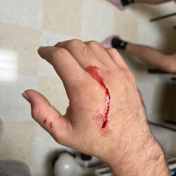 Baptist Health Medical Plaza - Palmetto Bay - Hole thru hand from bite