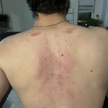 Massage Tao - Bruised after massage, way too much pressure and speed - Massage Near Me - Arvada, Colorado