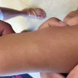 Pons'child Development Center One & Too - Bite mark 3 days later (bruised)