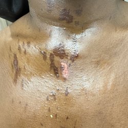 MEDcare Urgent Care - Summerville - Burn care