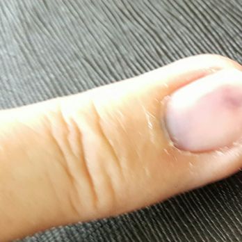 Golden China Buffet - Happens when finger tip caught in defective chair - Chinese Near Me - Radcliff, Kentucky