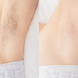 Nikki Noa RE - Smooth underarms after permanent hair removal using Thermolysis