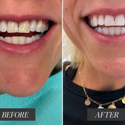 Dr. Ritzau replaced the discolored bonding and fixed the chips on my two front teeth and I walked out with a much more confident smile! Dr. Ritzau replaced the discolored bonding and fixed the chips on my two front teeth and I walked out with a much more confident smile!