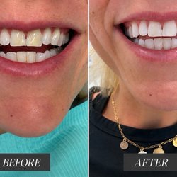 Shoreline Dental Studio - San Clemente - Dr. Ritzau replaced the discolored bonding and fixed the chips on my two front teeth and I walked out with a much more confident smile!