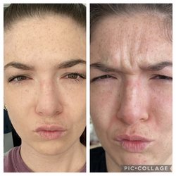Laganese Medispa - Botox before and after