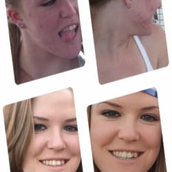 Before-above: age 18 After-below: age 23