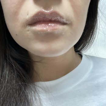Revenge MD - Before. - Skin Care Near Me - Las Vegas, Nevada Revenge MD - Before. - Skin Care Near Me - Las Vegas, Nevada
