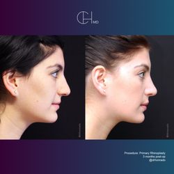 Carlo P Honrado, MD, FACS - Carlo Honrado, M.D., F.A.C.S.- Rhinoplasty & Septoplasty patient 8 months post-op