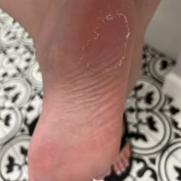 Leftover callous same night Leftover callous same night
