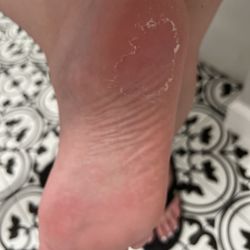 Lee Spa Nails - Leftover callous same night