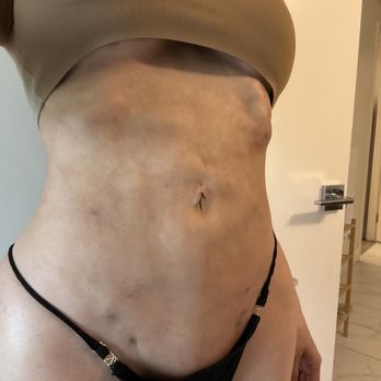PCH MedSpa - After edolift . I also asked that he do NOT open so many holes and he proceeded to do as he please ! - Medical Spas Near Me - Corona Del Mar, California PCH MedSpa - After edolift . I also asked that he do NOT open so many holes and he proceeded to do as he please ! - Medical Spas Near Me - Corona Del Mar, California