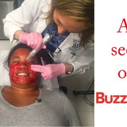 Jennifer Ahdout, MD - Buzzfeed featured the Vampire Facial at The Roxbury Institute amassing over 3 million viewers tuning in to see the treatment.
